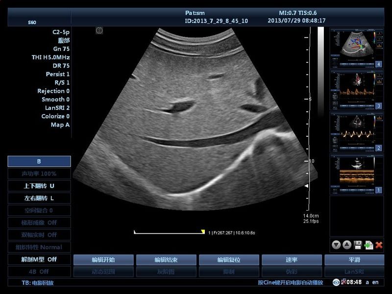 Krankenhaus Außerhalb Wagen 15 Zoll Ultraschallgerät Ultraschall Digitaler Farbdoppler Ultraschallgeräte Medizinisch